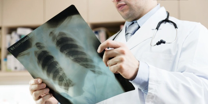 un medic care se uita peste o radiografie pulmonara