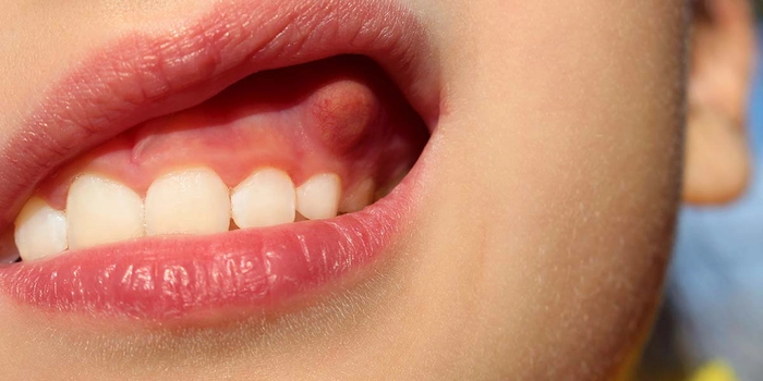 femeie care sufera de abces dentar