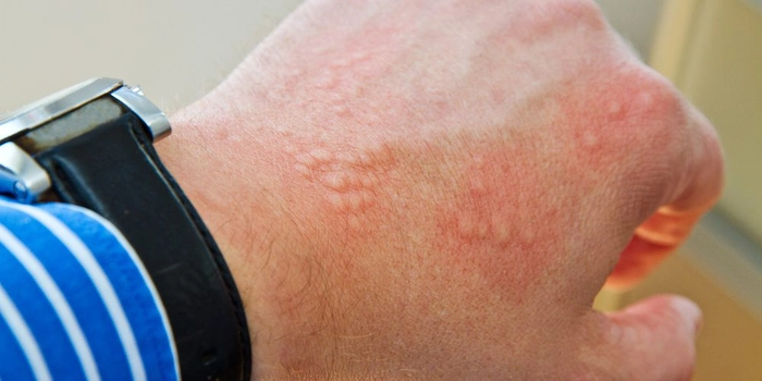 persoana care sufera de eczema pe maini