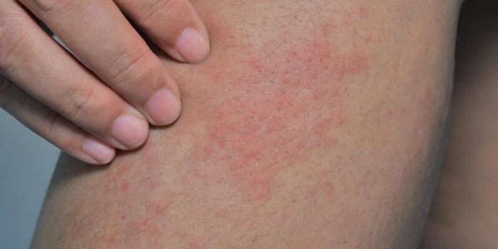 femeie care sufera de mancarimi a pielii