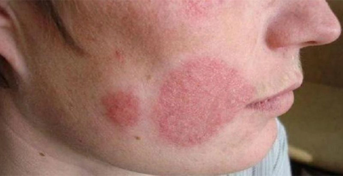 femeie care sufera de eruptii pe fata
