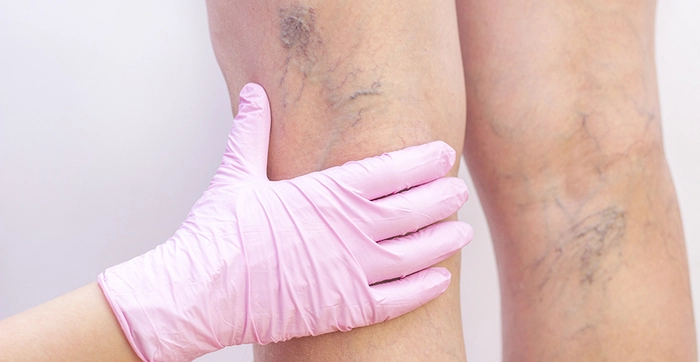 medic care examineaza varicele de pe picioarele unei persoane