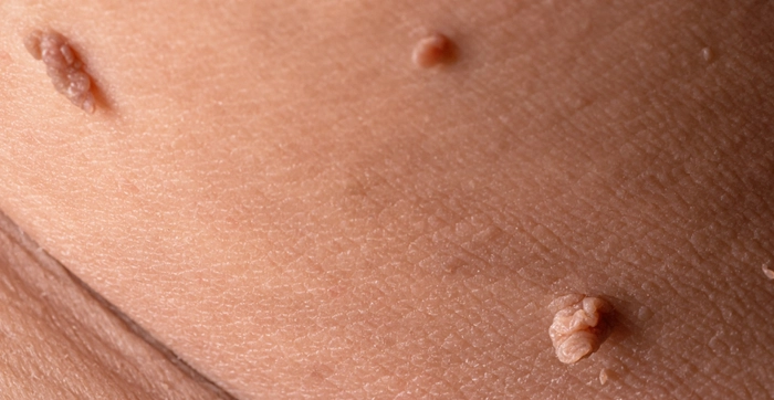 veruci pe corpul unei persoane provocate de hpv