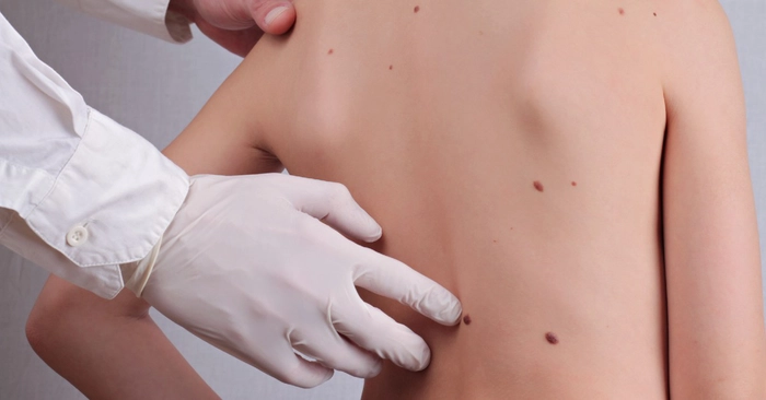 doctor care verifica alunitele de pe spatele unei persoane