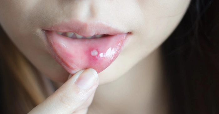 persoana care prezinta candida la nivel bucal