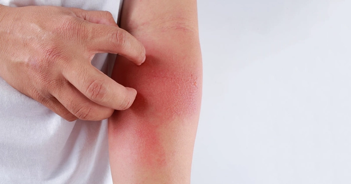 grafica persoana care sufera de mancarimi pe mana din cauza sistemului nervos