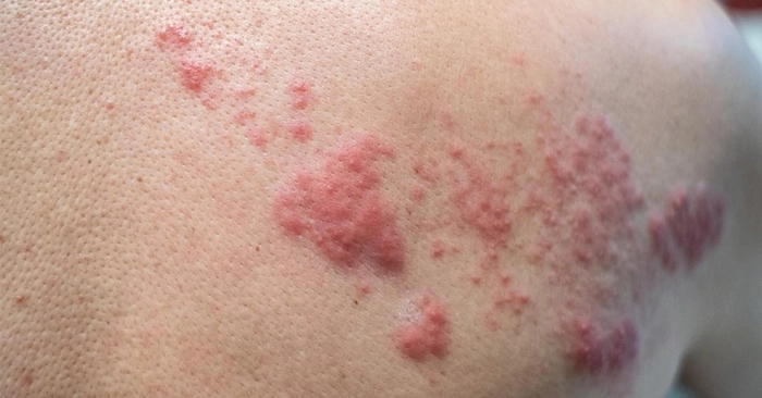 persoana care sufera de eruptii cutanate provocate de zona zoster pe spate
