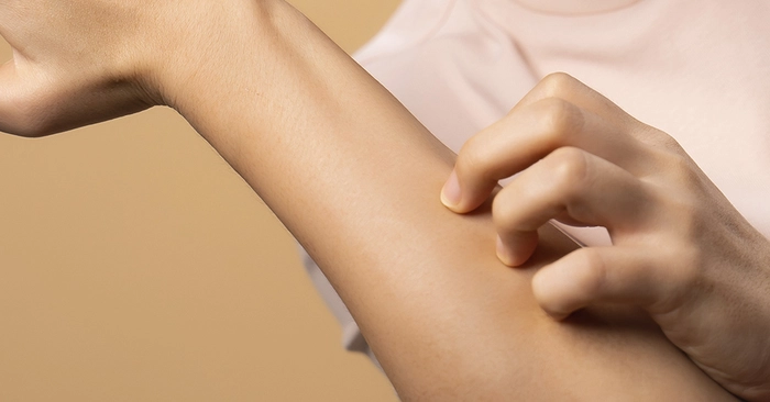 persoana care sufera de mancarimi din cauza eczemelor