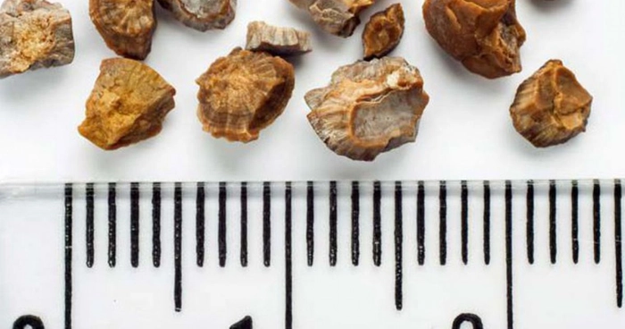 calculi biliari