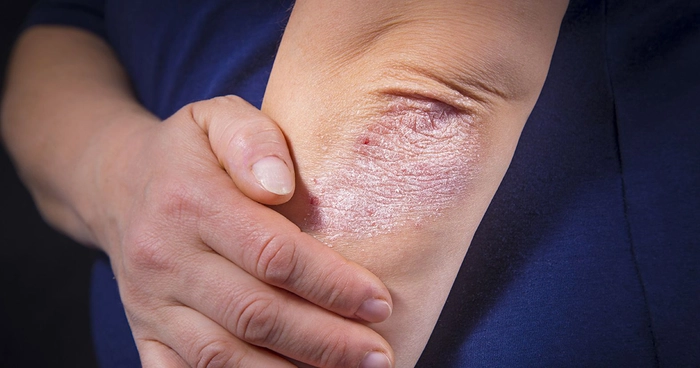 persoana care se tine de cot din cauza durerii provocate psoriazis