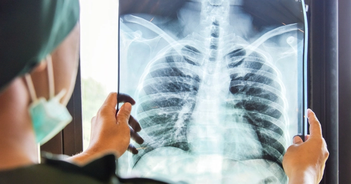 un medic care se uită pe o radiografie pulmonară