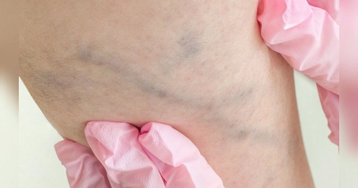 medic care analizeaza picioarele unei persoane care sufera de varice