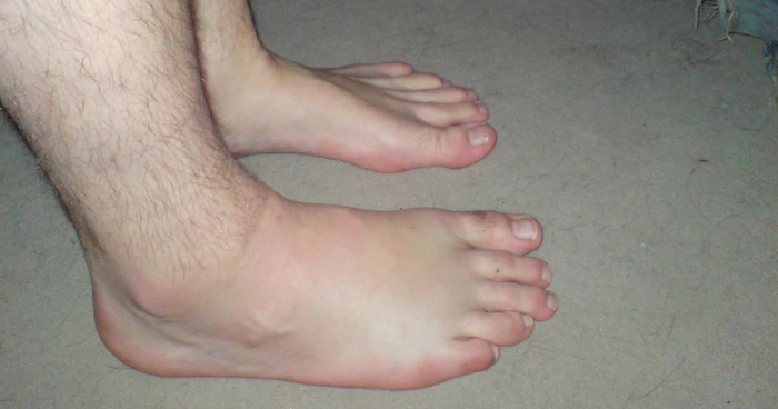 picioarele umflate ale unei persoane