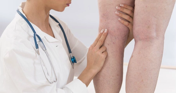 medic care analizeaza piciorul unei persoane afectat de tromboflebita