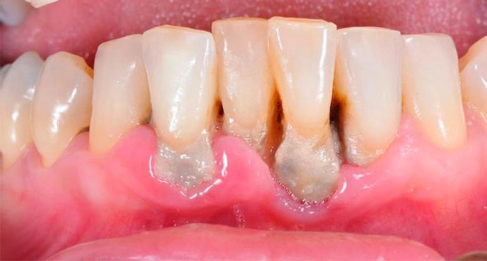 gingiile unei persoane afectate de cancer