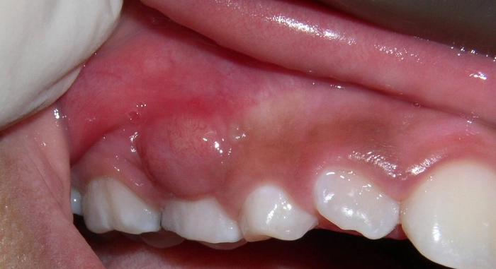 persoana care sufera de abces dentar