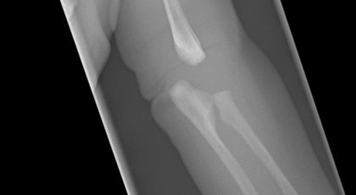 grafica in care se prezinta oasele dislocate ale unei persoane cu boala oaselor de sticla