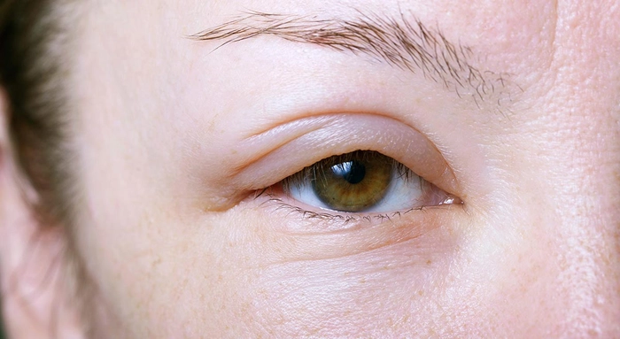 femeie care are pleoapa umflata