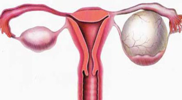 reprezentare a unui chist ovarian