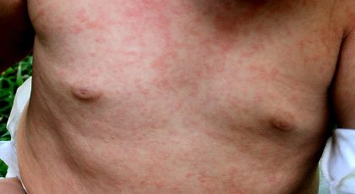 copil care suferp de Roseola Infantum