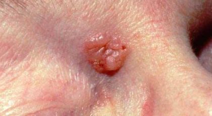 Carcinom bazocelular