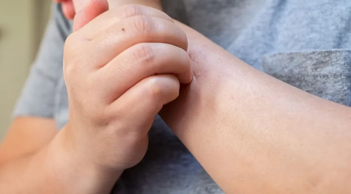 persoana care sufera de mancarimi pe mana din cauza sistemului nervos