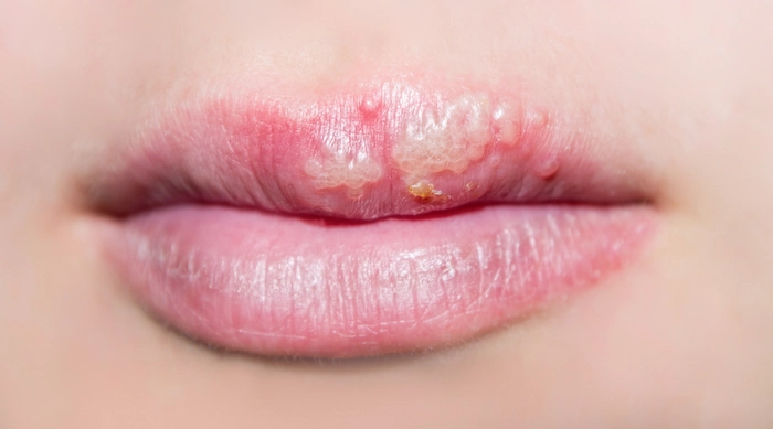 buzele unele persoane bolnave de herpes