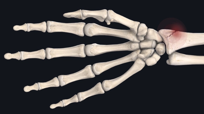 fractura la nivelul mainii