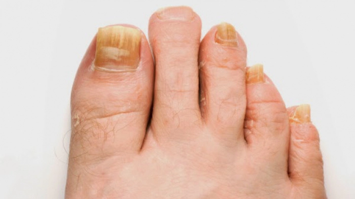 picior care are unghiile infectate