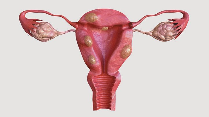 reprezentare grafică a endometriozei