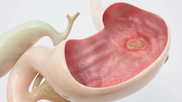 stomac ce prezinta ulcer