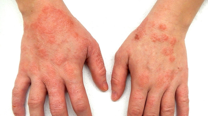 persoana care sufera de eczeme pe maini