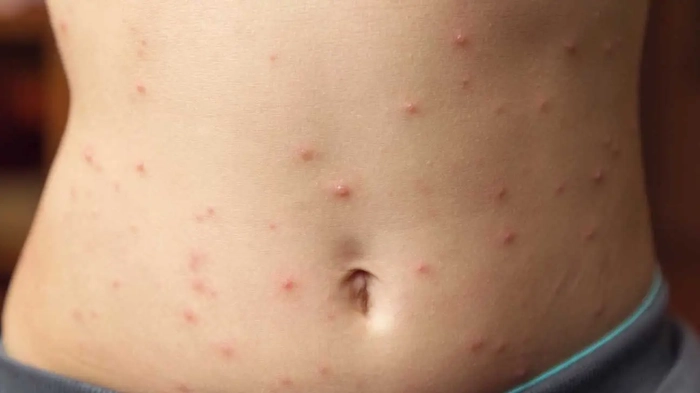 eruptii cutanate pe pielea unei persoane