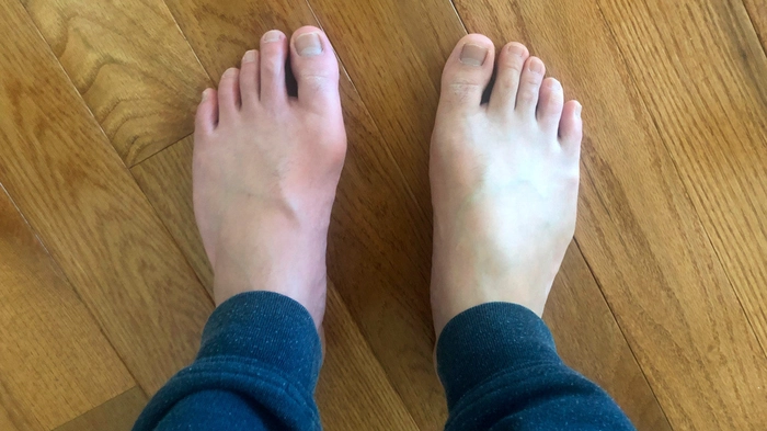 picioarele umflate ale unei persoane de la acid uric