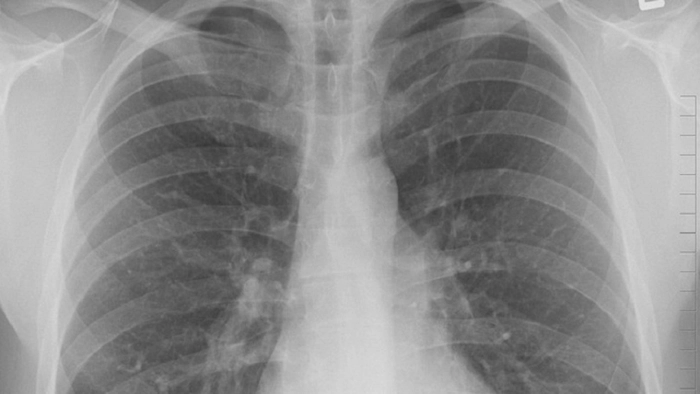 radiografie la plămâni