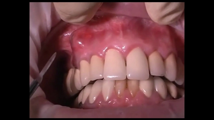 persoana care sufera de abces dentar