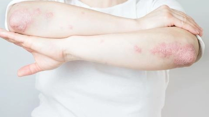 psoriazis maini