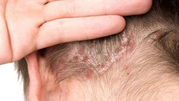 psoriazis pe scalp