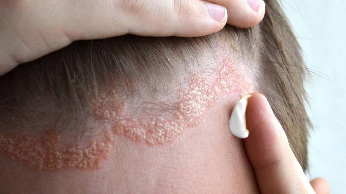psoriazis pe scalp