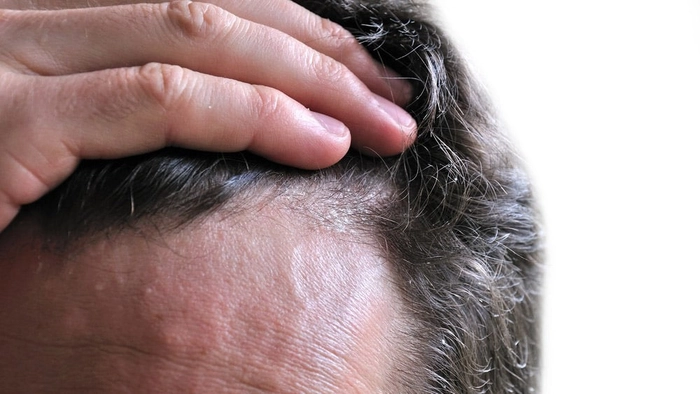 scalpul unei persoane care sufera de ciuperca de piele