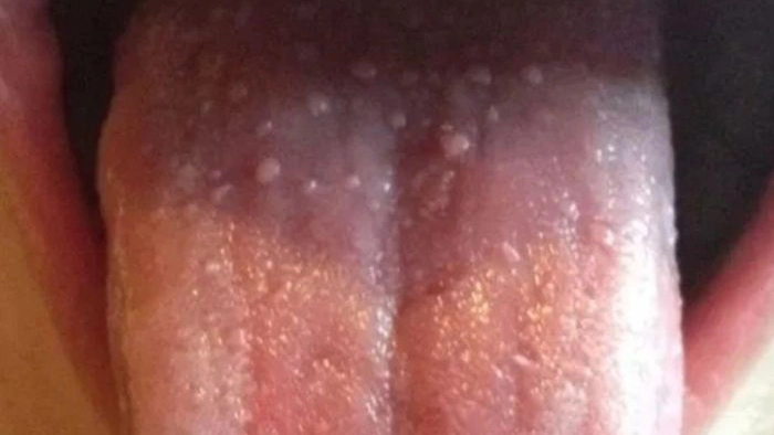 persoana cu limba scoasa afara pe care are bubite