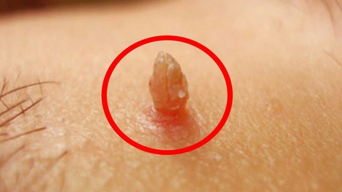 un veruce genital