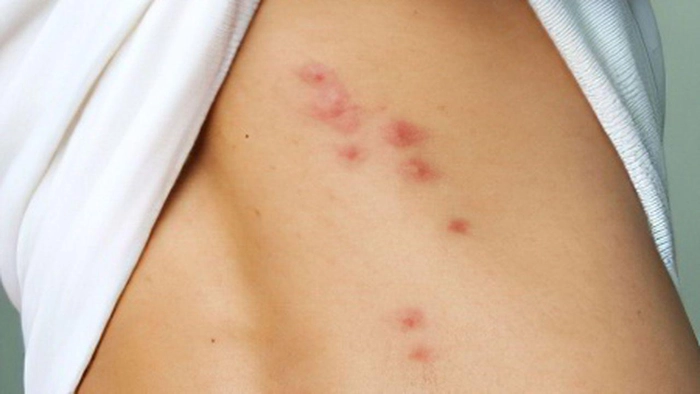 purpura trombocitopenică idiopatică pe spate