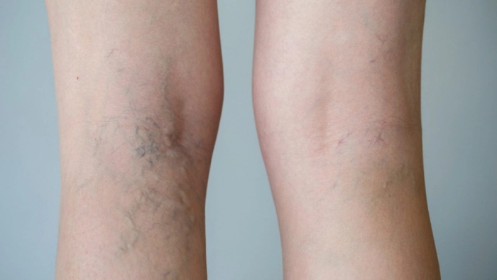 persoana care sufera de varice pe picioare