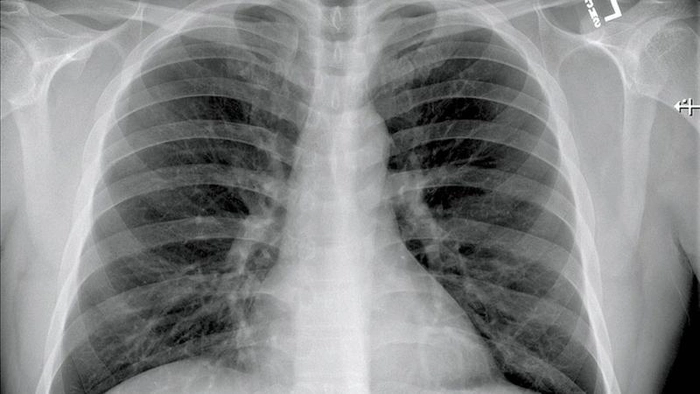 o radiografie pulmonară