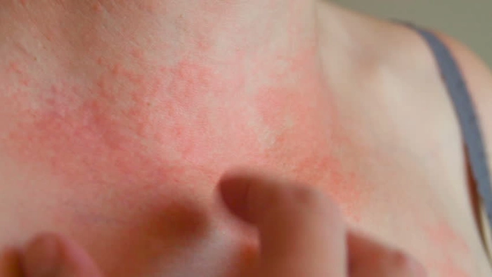 femeie care are eruptii cutanate pe gat si sufera de mancarimi