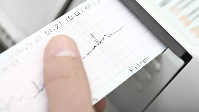 persoana care tine in mana un rezultat de la ekg