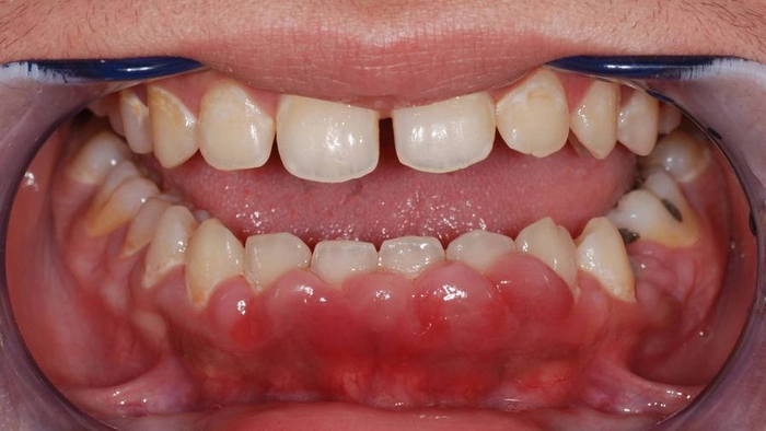persoana care sufera de abces dentar