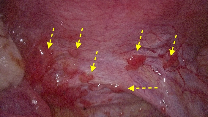 poză cu țesutul endometrial care a ajuns în cavitatea peritonială
