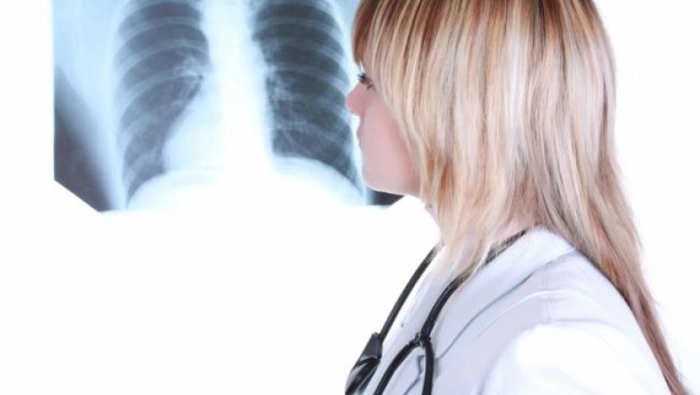 doctor care se uita la o radiografie a plamanilor